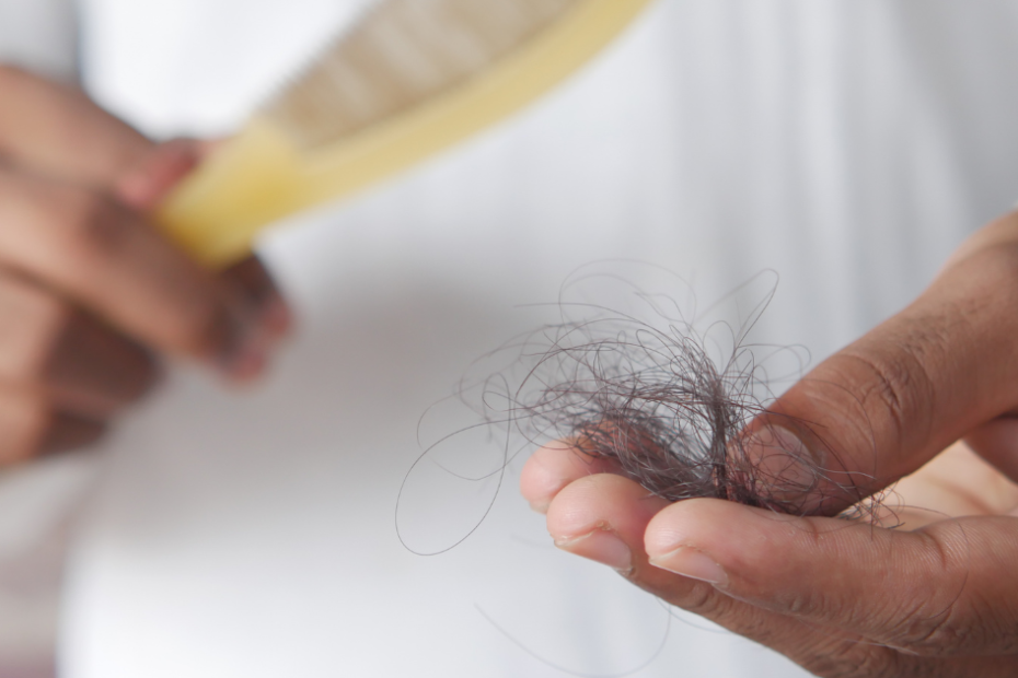 homem com queda de cabelo relacionado ao dht