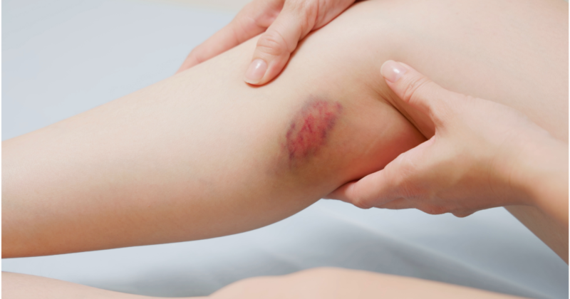 hematoma em mulher com plaquetas baixas