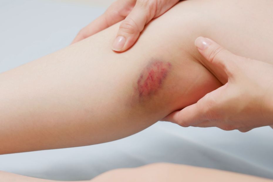 hematoma em mulher com plaquetas baixas