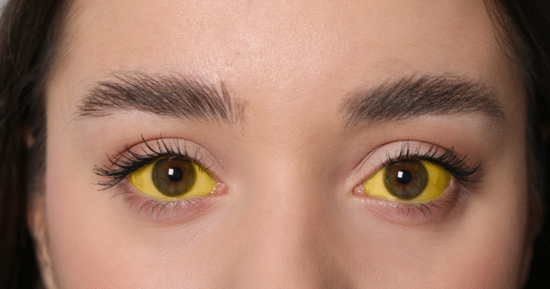Transmissão da Hepatite A: Mulher com olhos amarelados (icterícia), sintoma comum da hepatite A.