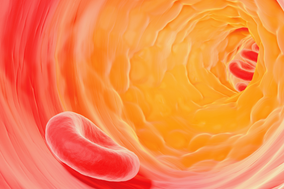 placa de ateroma representando risco residual cardiovascular.