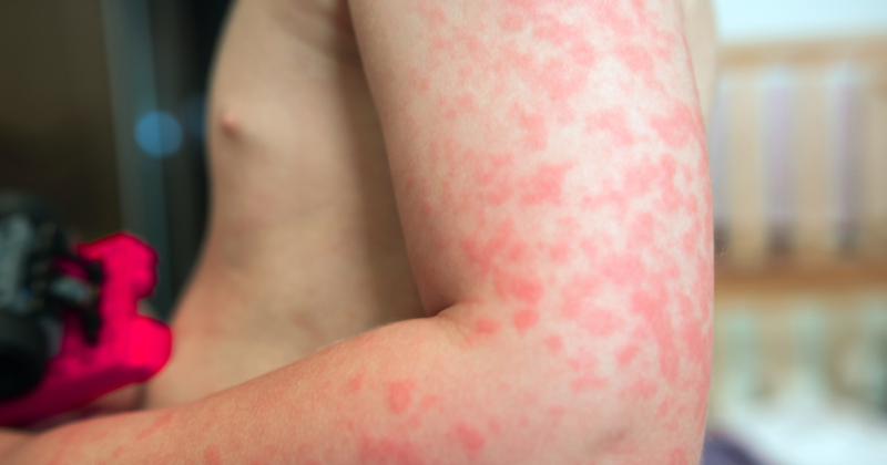 Alergias: Sintomas Persistentes e Exames de Sangue Manchas vermelhas na pele de bebê associadas a alergias.