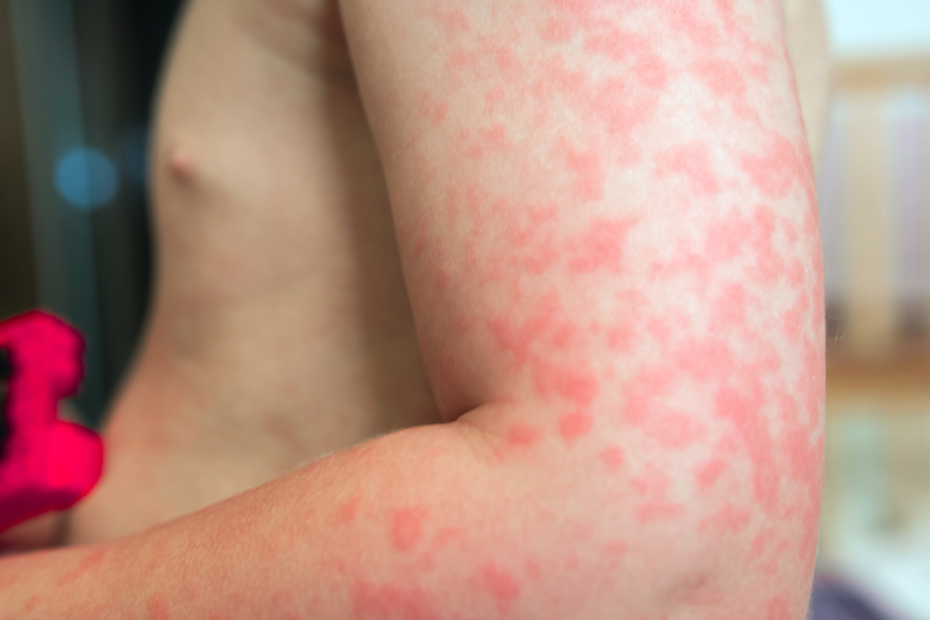 Manchas vermelhas na pele de bebê associadas a alergias.