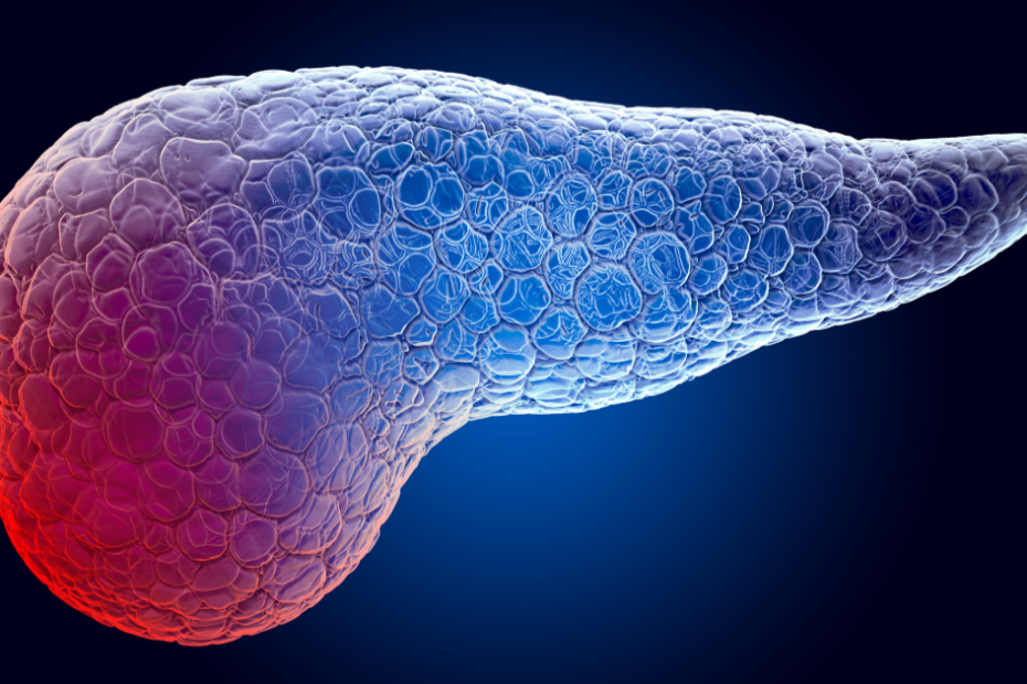 Ilustração do pâncreas com área destacada representando inflamação associada à alteração de amilase e lipase