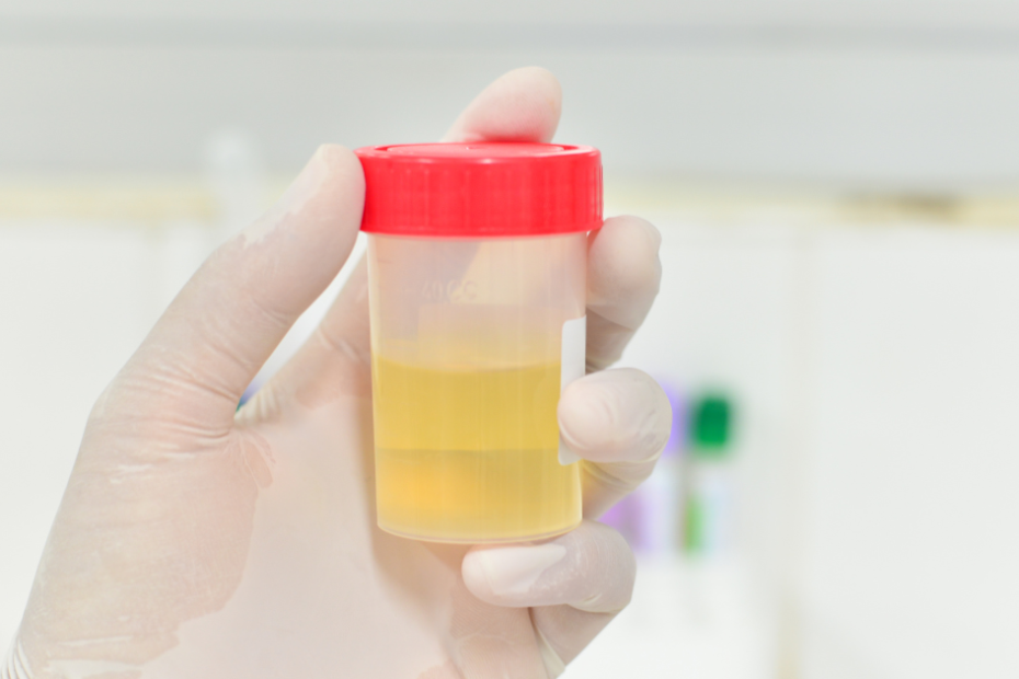 exame de gonorreia por PCR realizado em laboratório clínico com amostra de urina