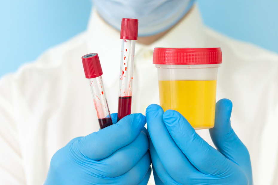 Profissional segurando frasco de urina e tubos de sangue para exame de proteinúria