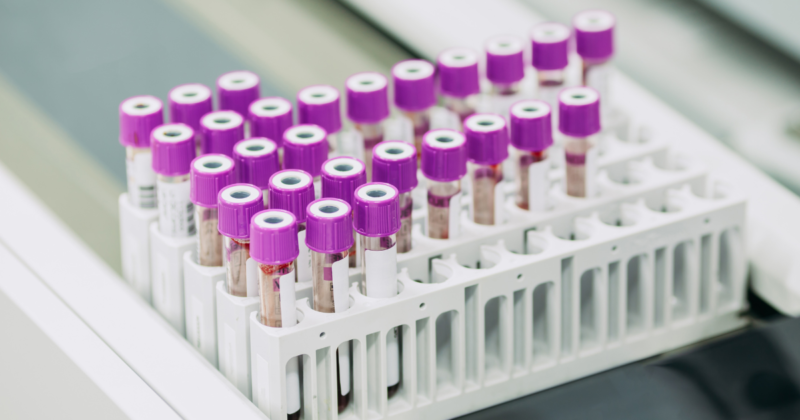 Marcadores tumorais femininos: quando alteram, o que significam e quando investigar Marcadores tumorais femininos em exame de sangue com tubos de amostras laboratoriais