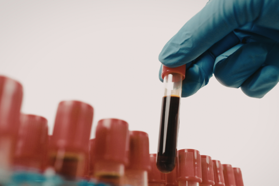 Exame de transferrina realizado por coleta de sangue em laboratório clínico