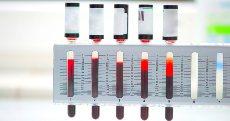 VHS exame: o que é, para que serve e quando a velocidade de hemossedimentação está alterada Tubos graduados do VHS exame (velocidade de hemossedimentação) mostrando diferentes níveis de sedimentação