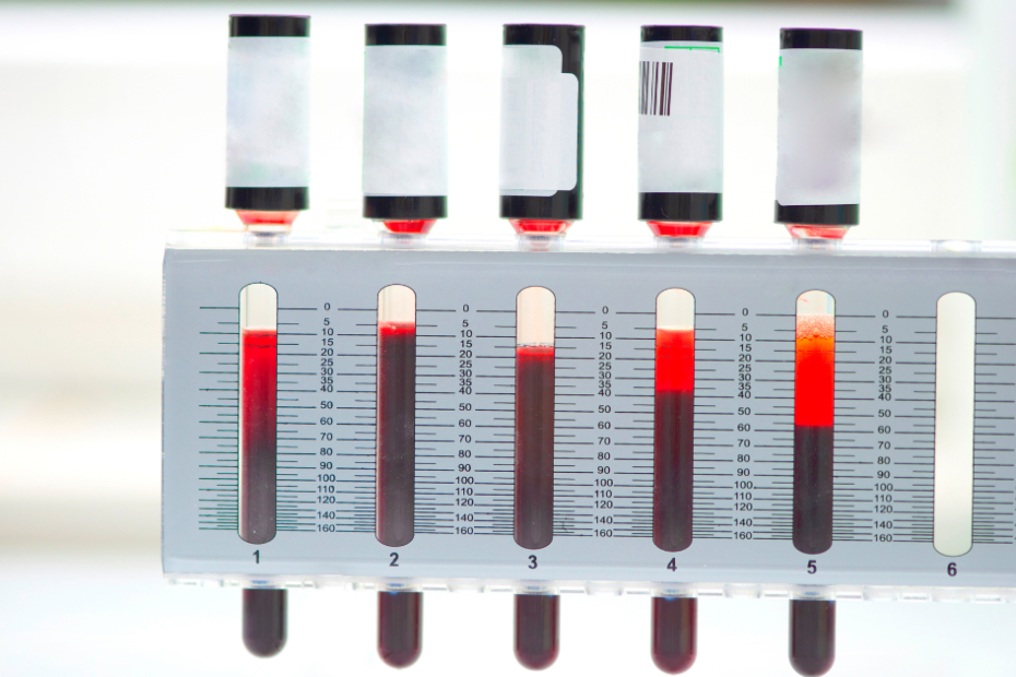 Tubos graduados do VHS exame (velocidade de hemossedimentação) mostrando diferentes níveis de sedimentação