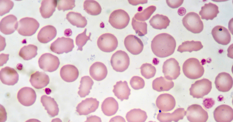 Vitamina B12 e anemia: hemácias observadas em lâmina de sangue