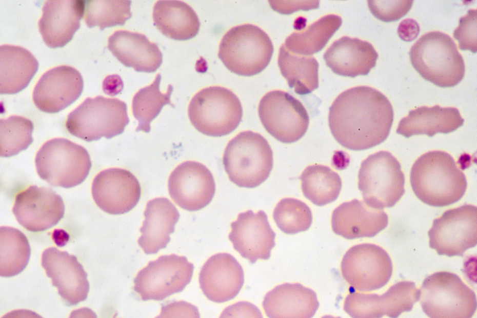 Vitamina B12 e anemia: hemácias observadas em lâmina de sangue