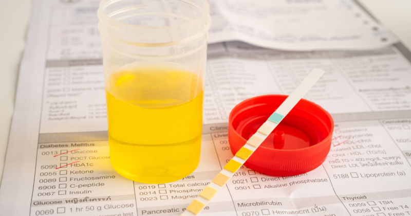 Glicose na Urina: O Que Significa, Causas e Quando Pode Indicar Diabetes amostra sendo testada para glicose na urina.