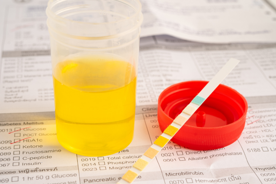 amostra sendo testada para glicose na urina.