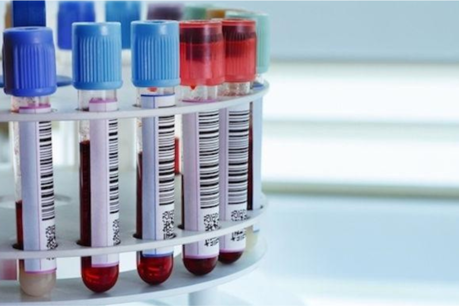 fator reumatoide alto exame de sangue interpretação resultados