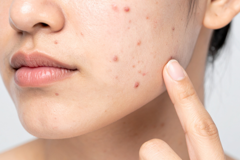 dht em mulheres relacionado à acne hormonal